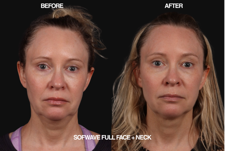 Before and after comparison of a woman's face with SOFWAVE Full Face + Neck treatment.