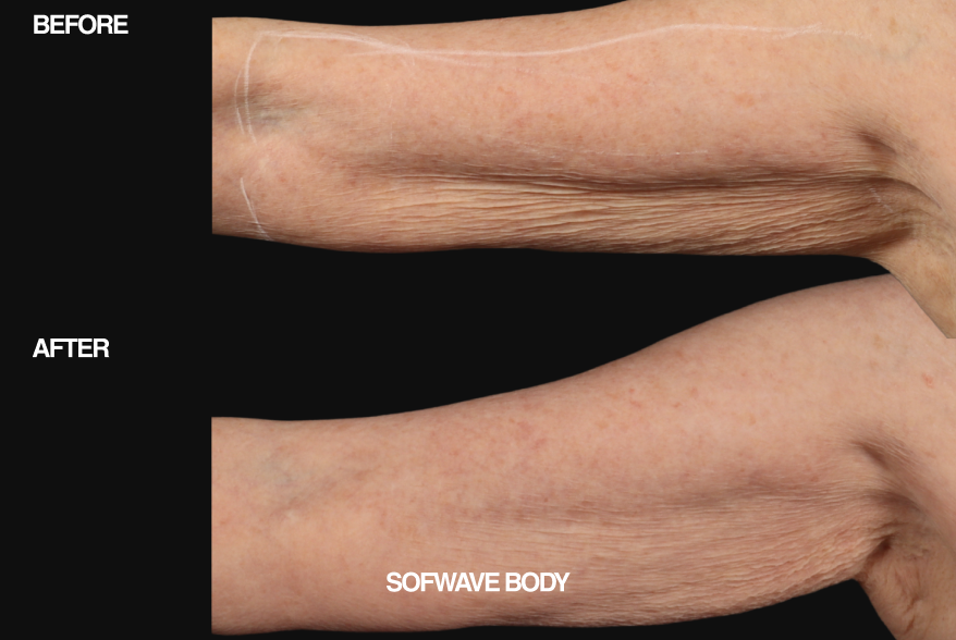 Before and after comparison of Sofwave Body treatment on a person's arm.