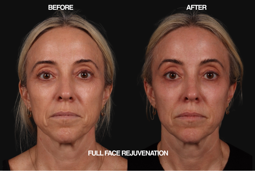 Before and after comparison of full face rejuvenation on a person with blonde hair.