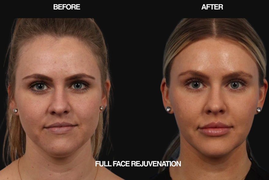 Before and after comparison of full face rejuvenation on a woman with blonde hair.