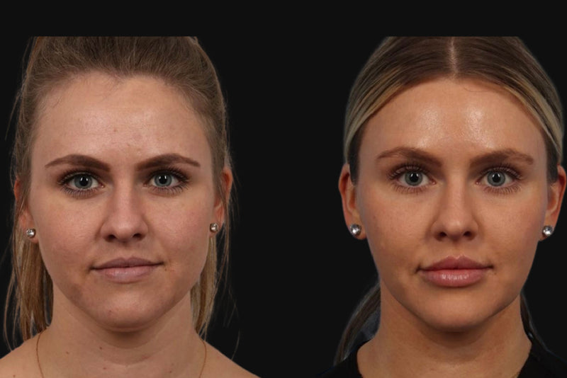 Under Eye Filler before & after treatment