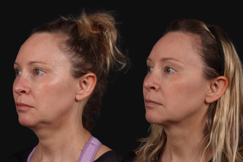 Full Face Rejuvenation before & after treatment