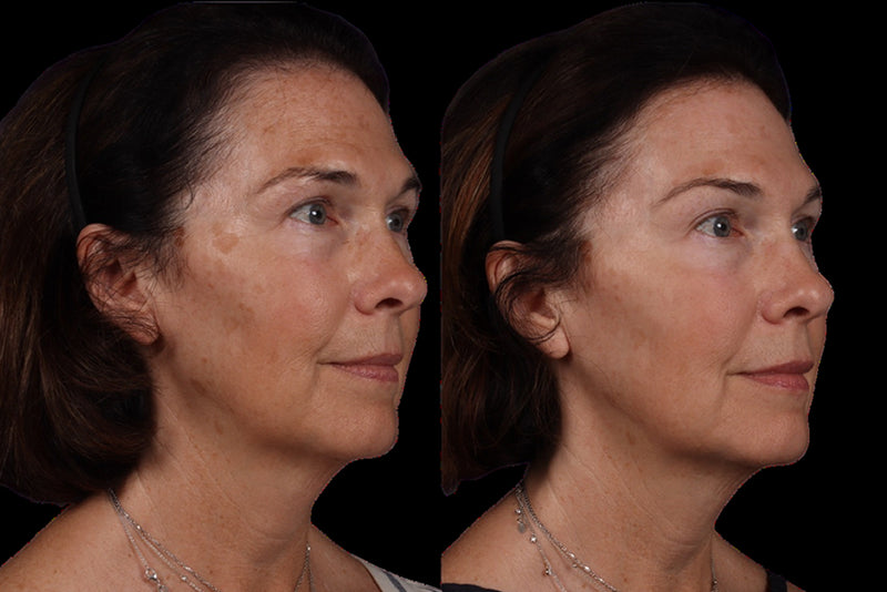 BBL + Moxi before & after trreatment