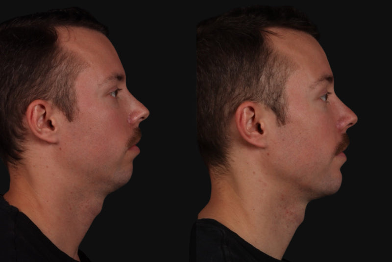 Sofwave Full Face before & after treatment