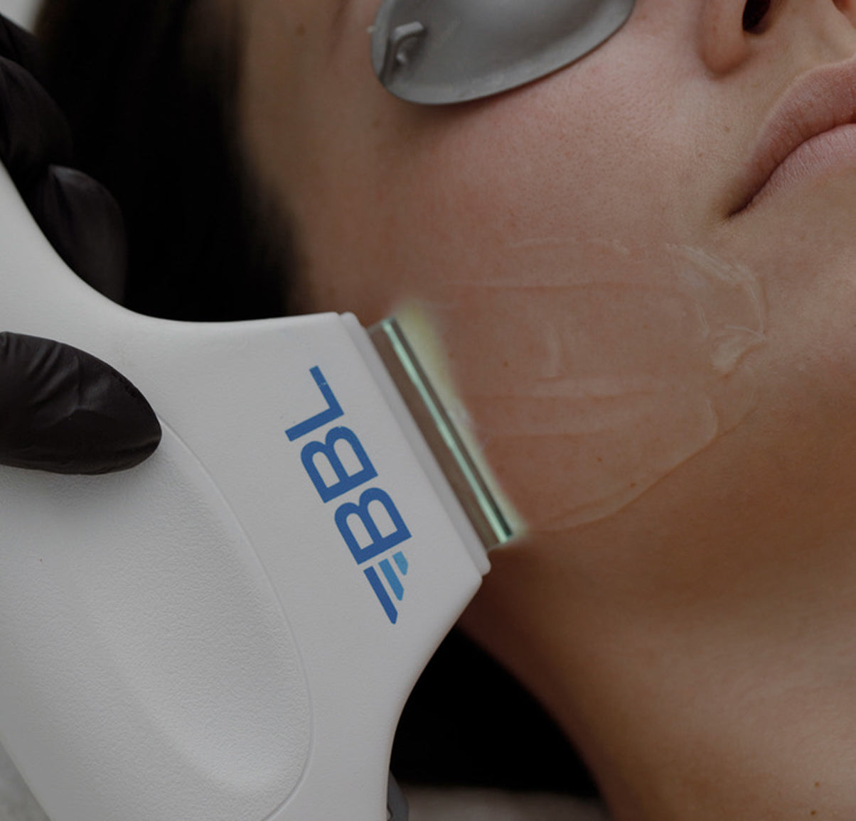 laser treatment